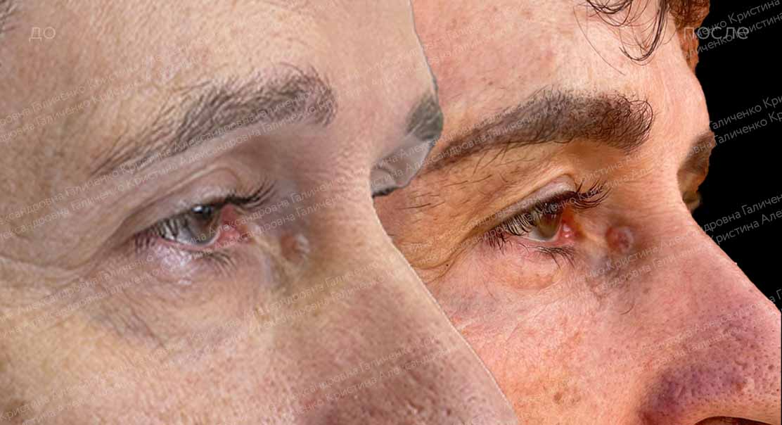 Классическая нижняя блефаропластика