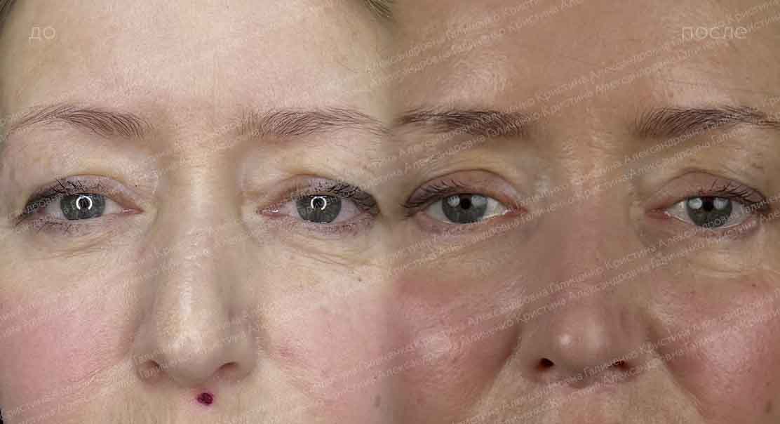 Булхорн + нижняя блефаропластика