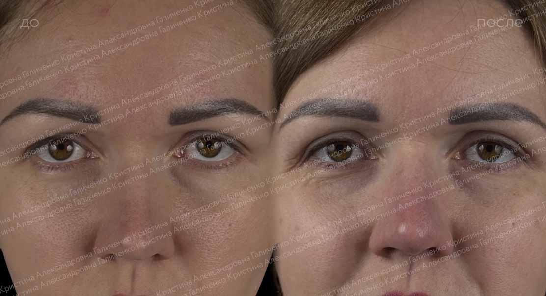 Верхняя блефаропластика