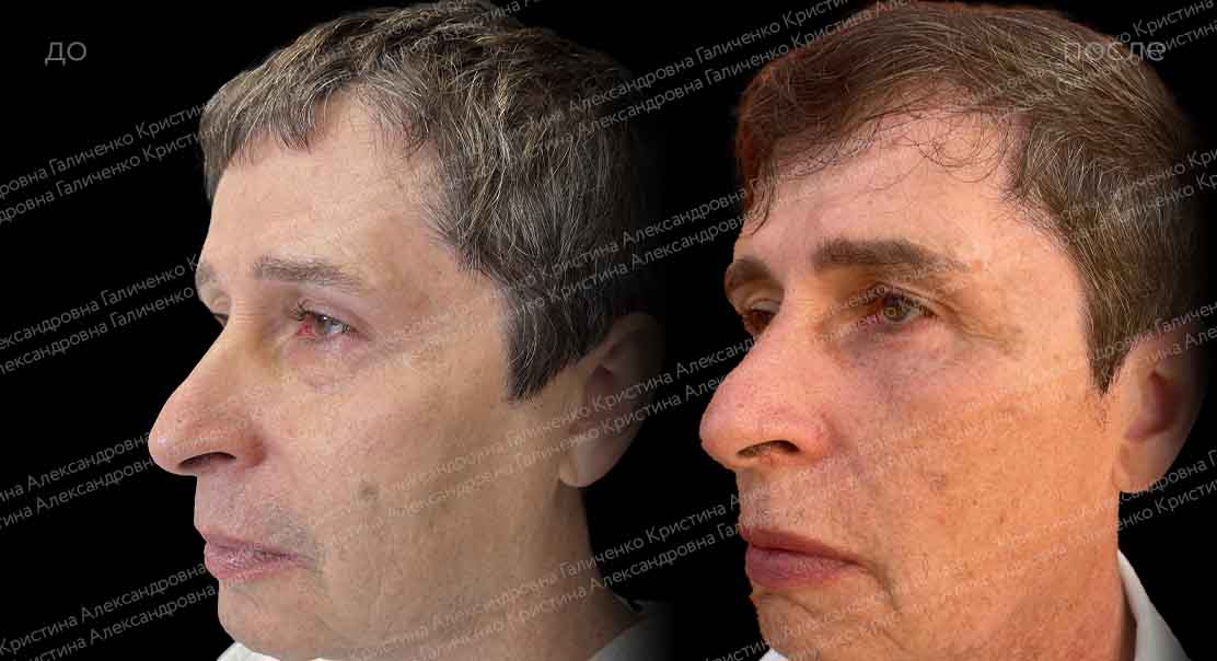 Классическая нижняя блефаропластика