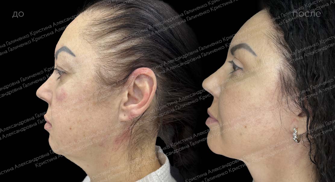 фото до/после подтяжки кожи лица