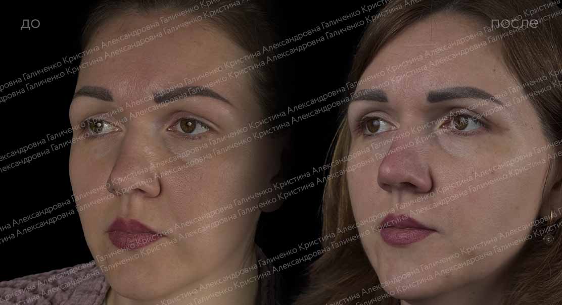 Верхняя блефаропластика
