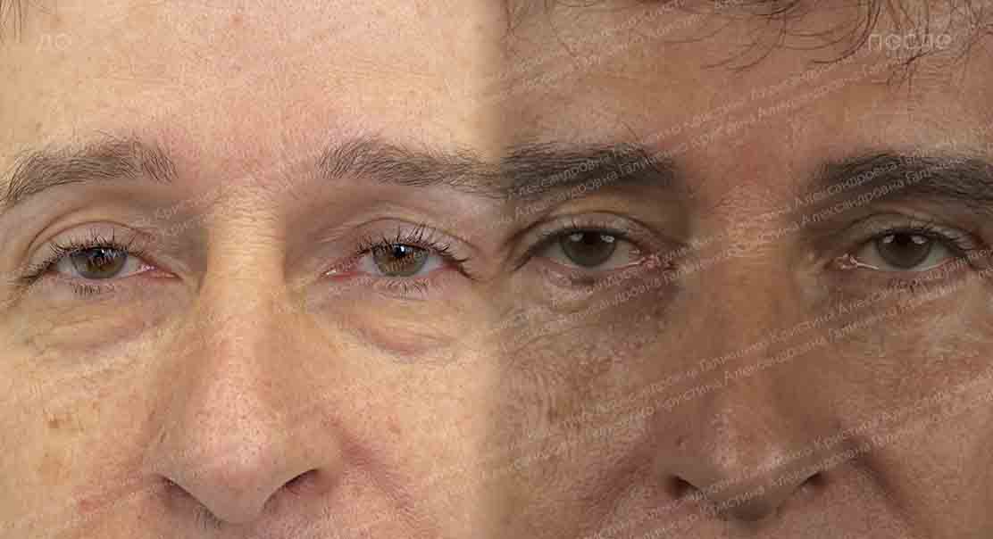 Нижняя блефаропластика