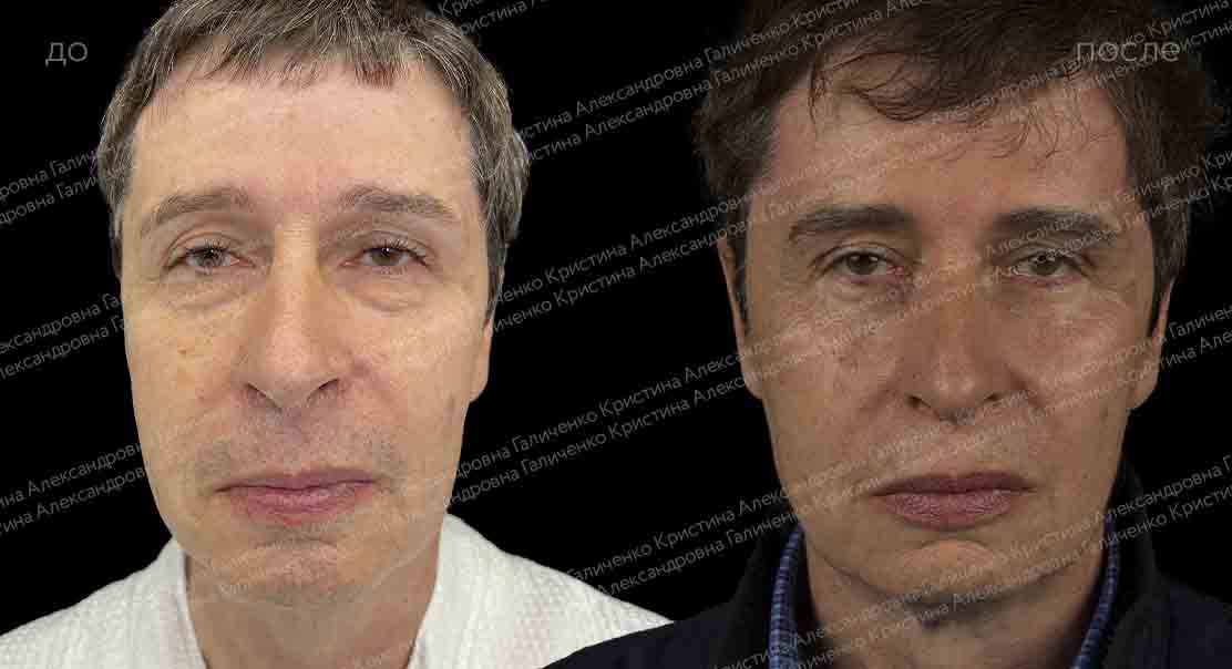 Нижняя блефаропластика