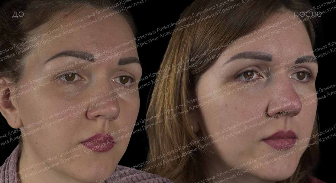 Верхняя блефаропластика