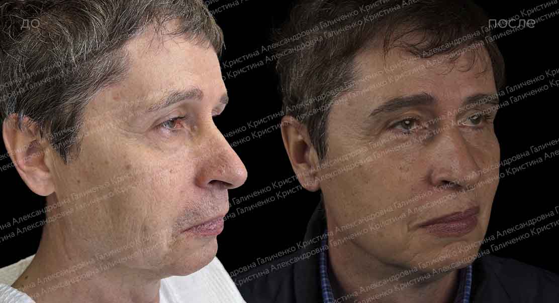 Нижняя блефаропластика