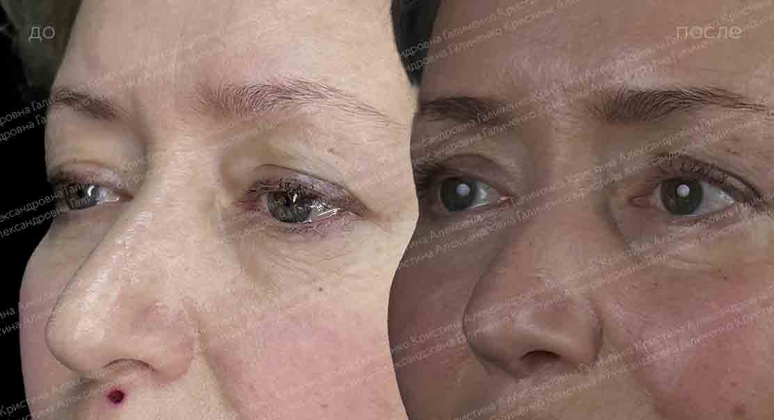 Булхорн + нижняя блефаропластика