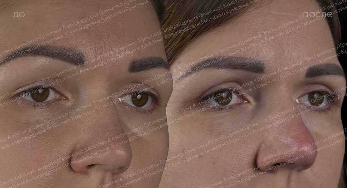 Верхняя блефаропластика
