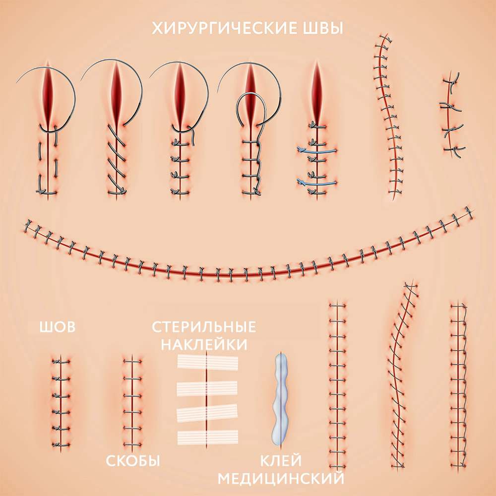 типы хирургических швов